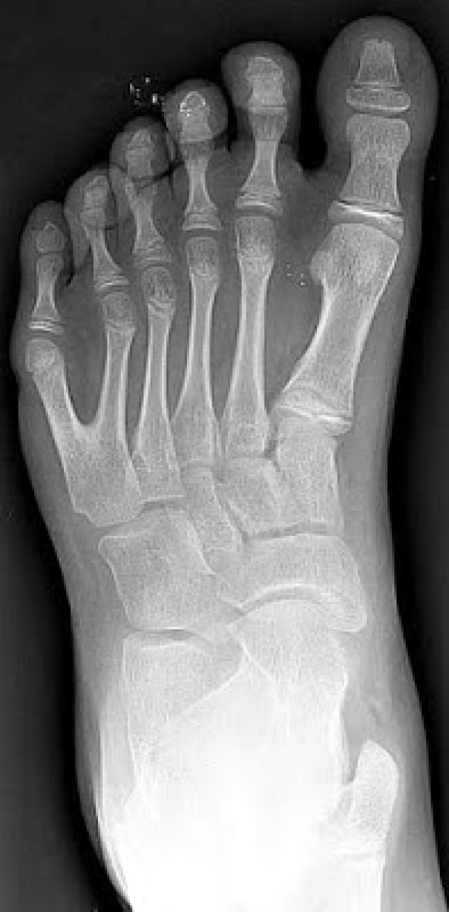 Radiografía de un pie izquierdo con polidactilia y parece haber sido un patrón habitual entre las razas de gigantes